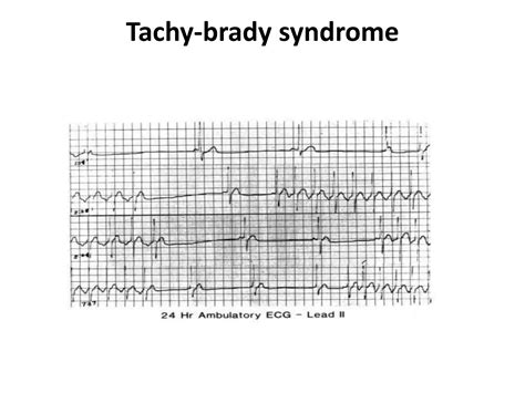 Sick sinus syndrome | PPTX