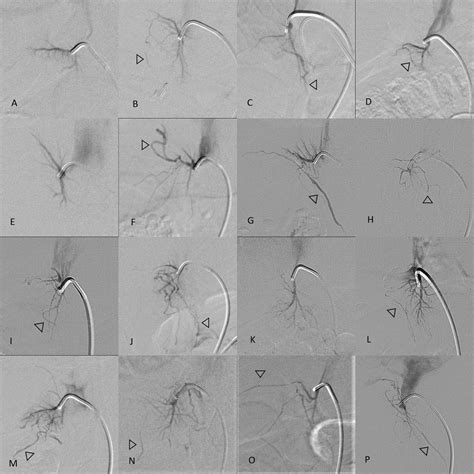 Adrenal venous sampling in primary aldosteronism: lessons from over 600 single-operator ...