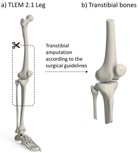 Development of a Generic Numerical Transtibial Model for Limb ...