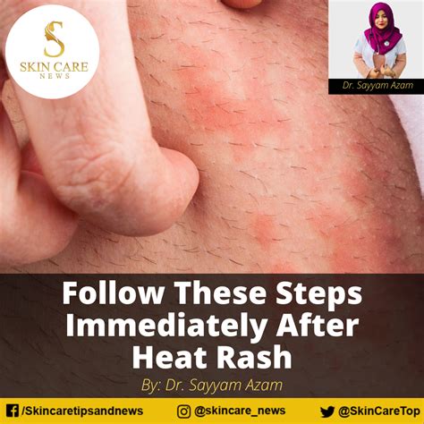 How To Stop Heat Rash Between Legs at Adriana Fishburn blog