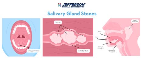 Salivary Gland Stone How To Spot Salivary Stones In Children: Signs