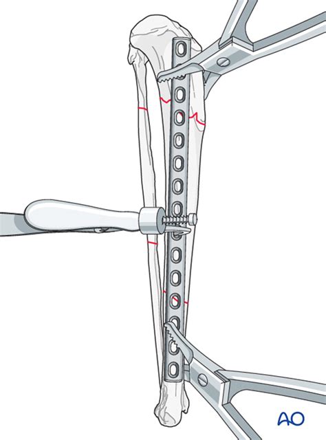 Compression Plate Ao 的图像结果