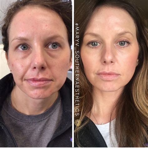 Microneedling with PRP | Skin tightening treatments, Facial aesthetics, Facial contouring