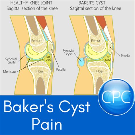 Baker's Cyst Knee Va Rating at Patricia Sanchez blog