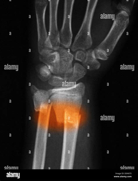 Ulna Fracture X Ray Distal Radius And Ulna Fractures | Radiology Case