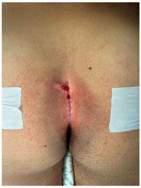 Pilonidal Sinus: Open Surgery or PEPSiT? Our Preliminary Experience in ...