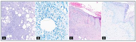 A Report of Two Uncommon Cases of Mycobacterium chelonae with Localized ...