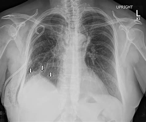Case 287: Intrathoracic Migration of a Breast Implant after Video-assisted Thoracoscopic Surgery ...