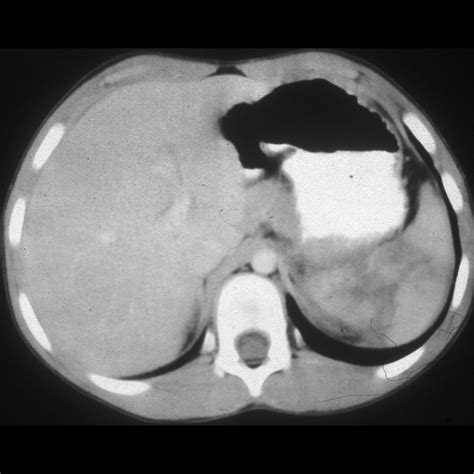 Pediatric Splenic Trauma | Pediatric Radiology Reference Article ...