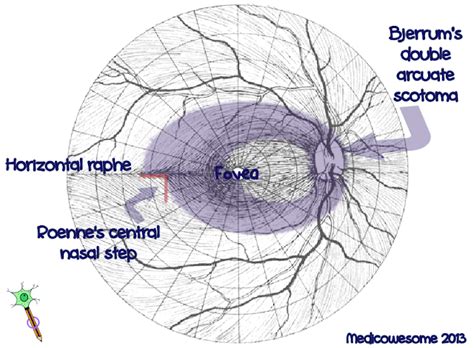 Image result for Nasal Step Visual Field Defect