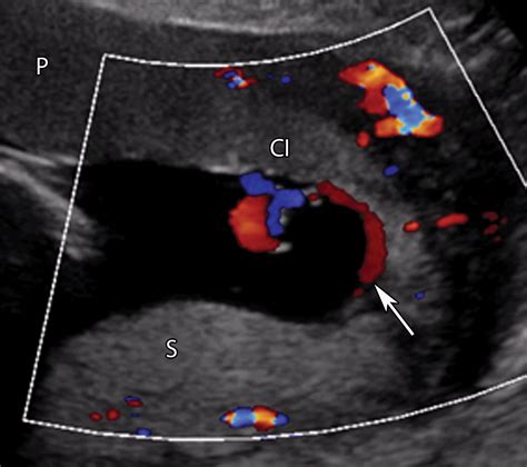 Placental Imaging: Normal Appearance with Review of Pathologic ...