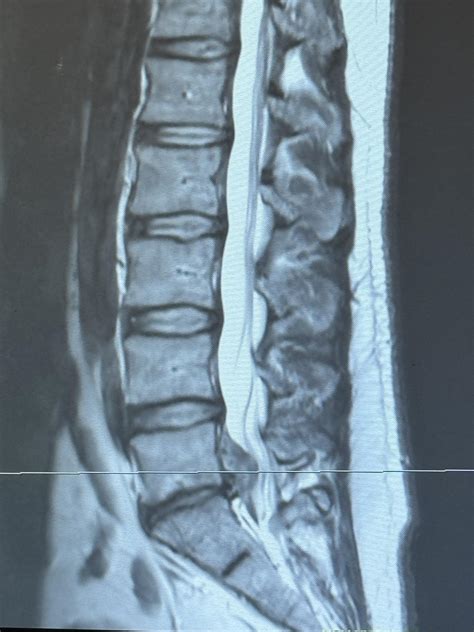 L5-S1 MRI : r/backpain