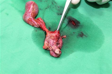 Choledocal Cyst - 28 year old young lady with abdominal pain was ...