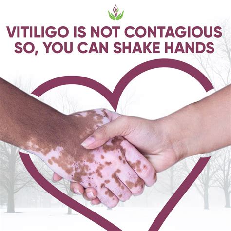 Is Vitiligo Contagious