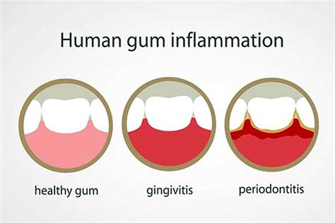 Gum Pain Help