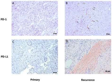 Comparison of Immune Checkpoint Molecules PD-1 and PD-L1 in Paired ...