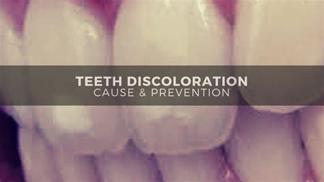 Teeth Discoloration - Cause & Prevention