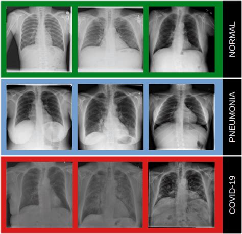 Hospital X-ray Chest 的图像结果