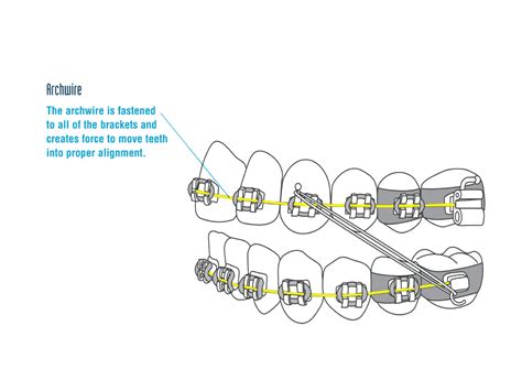 Brackets de ortodoncia: ¿cómo funcionan? | Ortodoncia ART