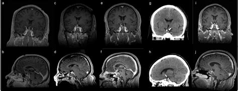 The Role of Surgical Approaches in the Multi-Modal Management of Adult ...