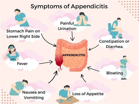 Image result for Appendicitis Assessment Signs