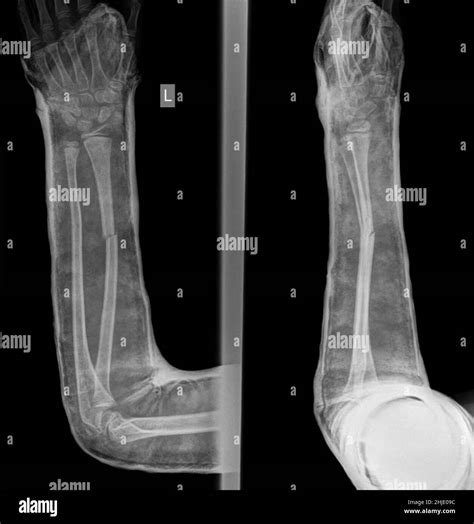 Fractured hand in cast, X-ray Stock Photo - Alamy