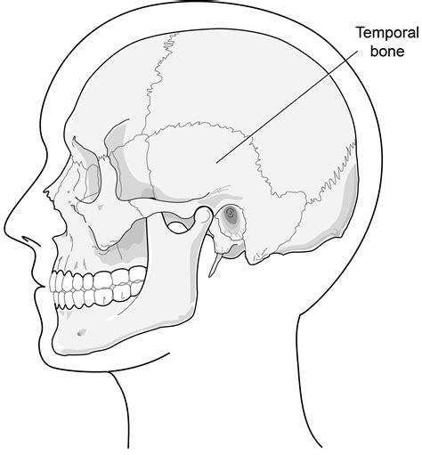 Basal Skull Fracture Temporal Bone at Angelina Chomley blog - petrous temporal bone