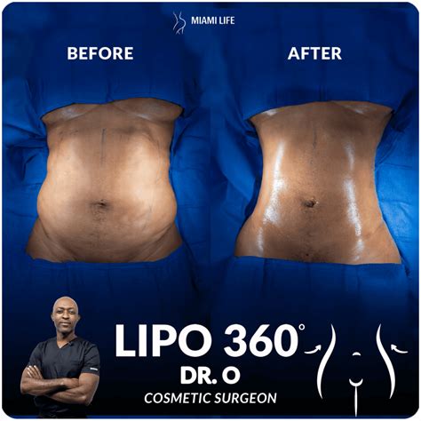 Lipo 360 – Miami Life Cosmetic Surgery