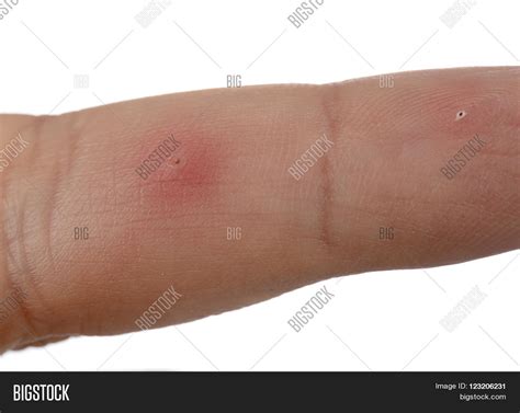 Image result for Splinter in Hand