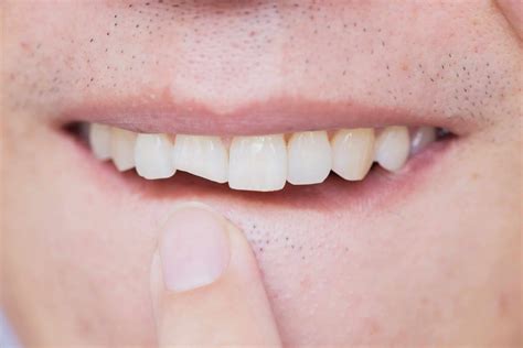 Chipped Teeth Can Cause More Than Cosmetic Issues For Your Smile