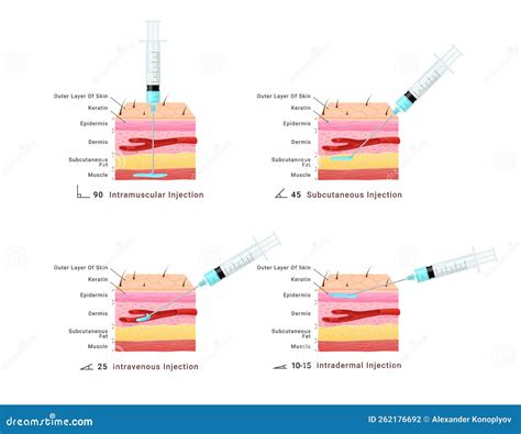 Injection Types 的图像结果