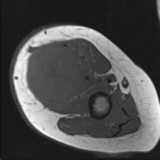 Image result for Soft Tissue Sarcoma Hand