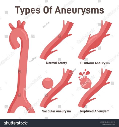 329 Arch Aorta Images, Stock Photos & Vectors | Shutterstock