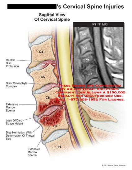 AMICUS Illustration of amicus,injury,injuries,cervical,spine,MRI ...