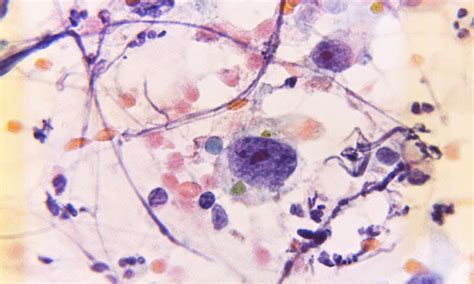 Breastfeeding may reduce risk of leukemia in children