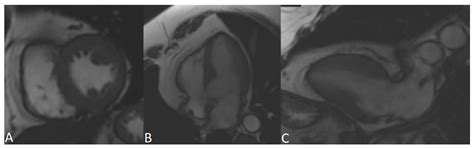 New Variant in Placophilin-2 Gene Causing Arrhythmogenic Myocardiopathy