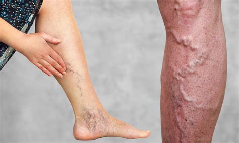 Medfin BlogVaricose Veins vs Spider Veins: What’s the Difference ...