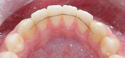 Image result for Retainer Problems