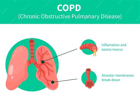 Menselijke Longen vector clip art icon COPD vector illustratie ...