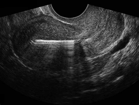 Paragard Iud Ultrasound