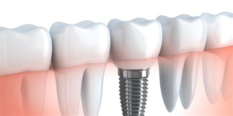 3 Simple Reasons Why You Can Trust Dental Implant Safety - IOSC