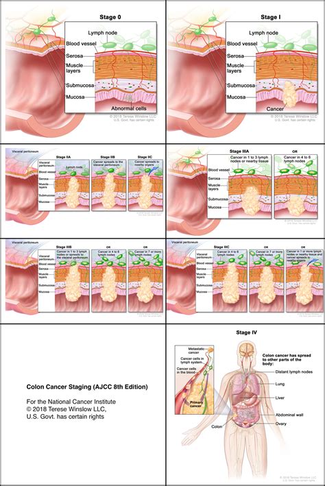 Rectal Cancer Staging Rectal Cancer: Symptoms, Causes And Stages | Max