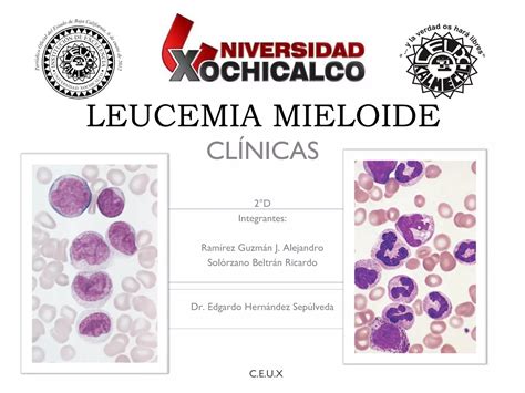 Leucemia mieloide: síntomas, diagnóstico y tratamiento | PPT