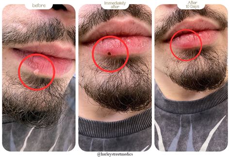 Wart Removal London – Fast Relief | Harley Street Medics