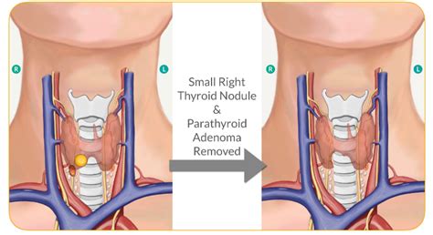 Thyroid Nodule Management - parathyroid