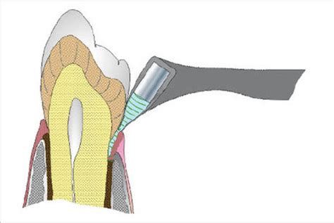 Heavy metals in baby teeth linked with autism : NIH study