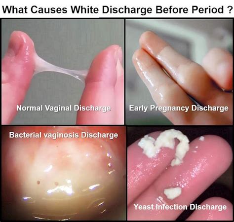 White Vaginal Discharge Before Period