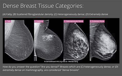 Normal Mammogram With Density