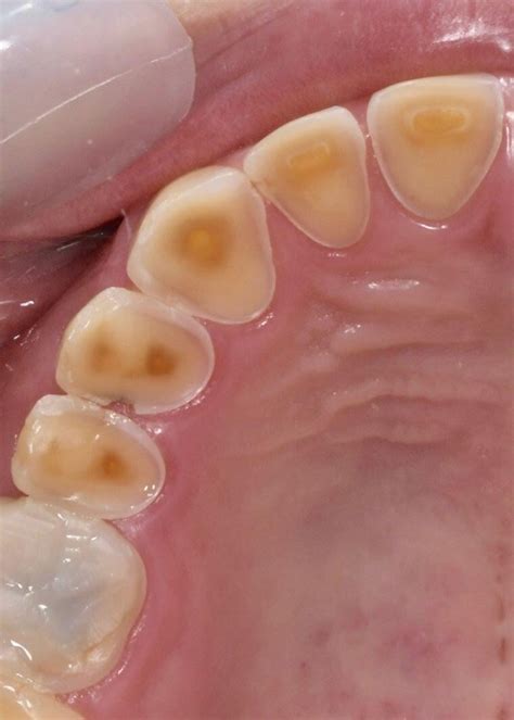 Home Remedies for Bruxism: Ways to Prevent Attrition