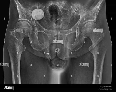 Incontinence implant. Frontal X-ray of the pelvic region of a 62-year-old patient with an ...